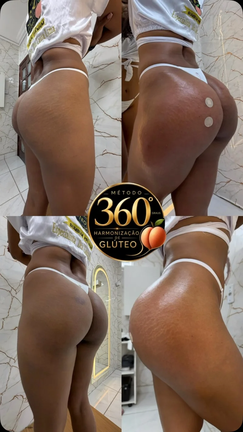 Antes e depois de harmonização glútea