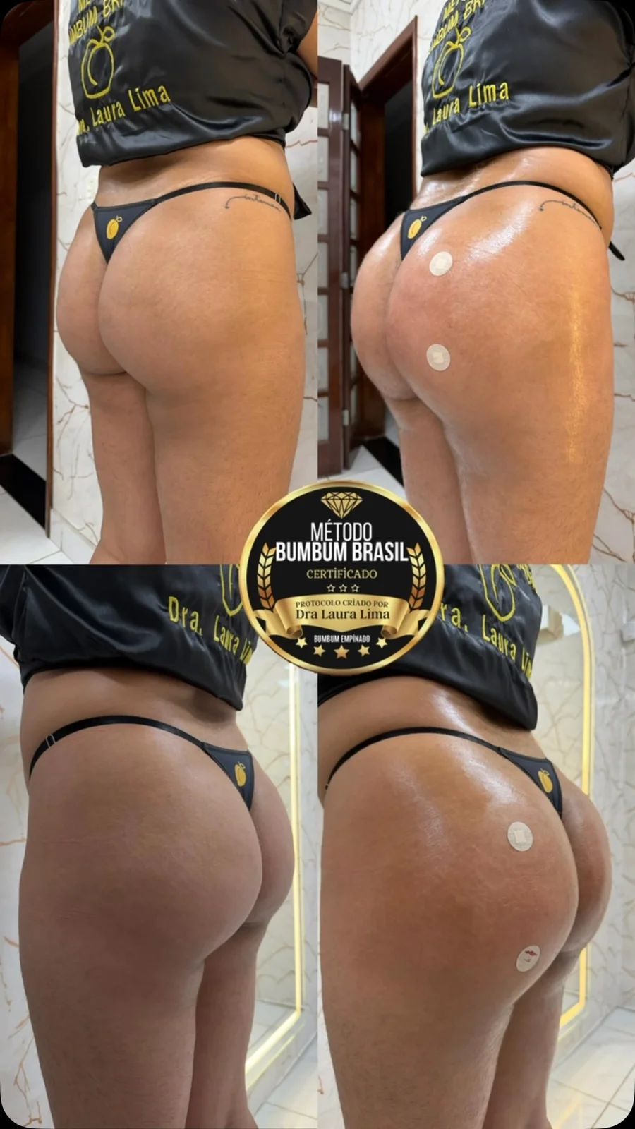 Antes e depois de harmonização glútea