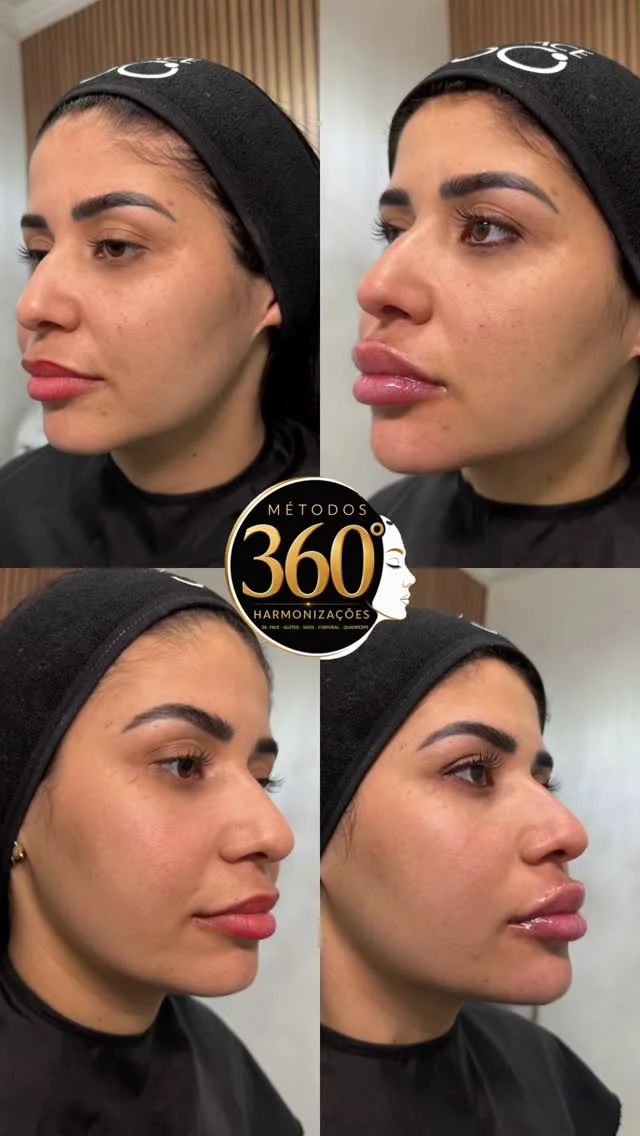 Antes e depois de harmonização labial