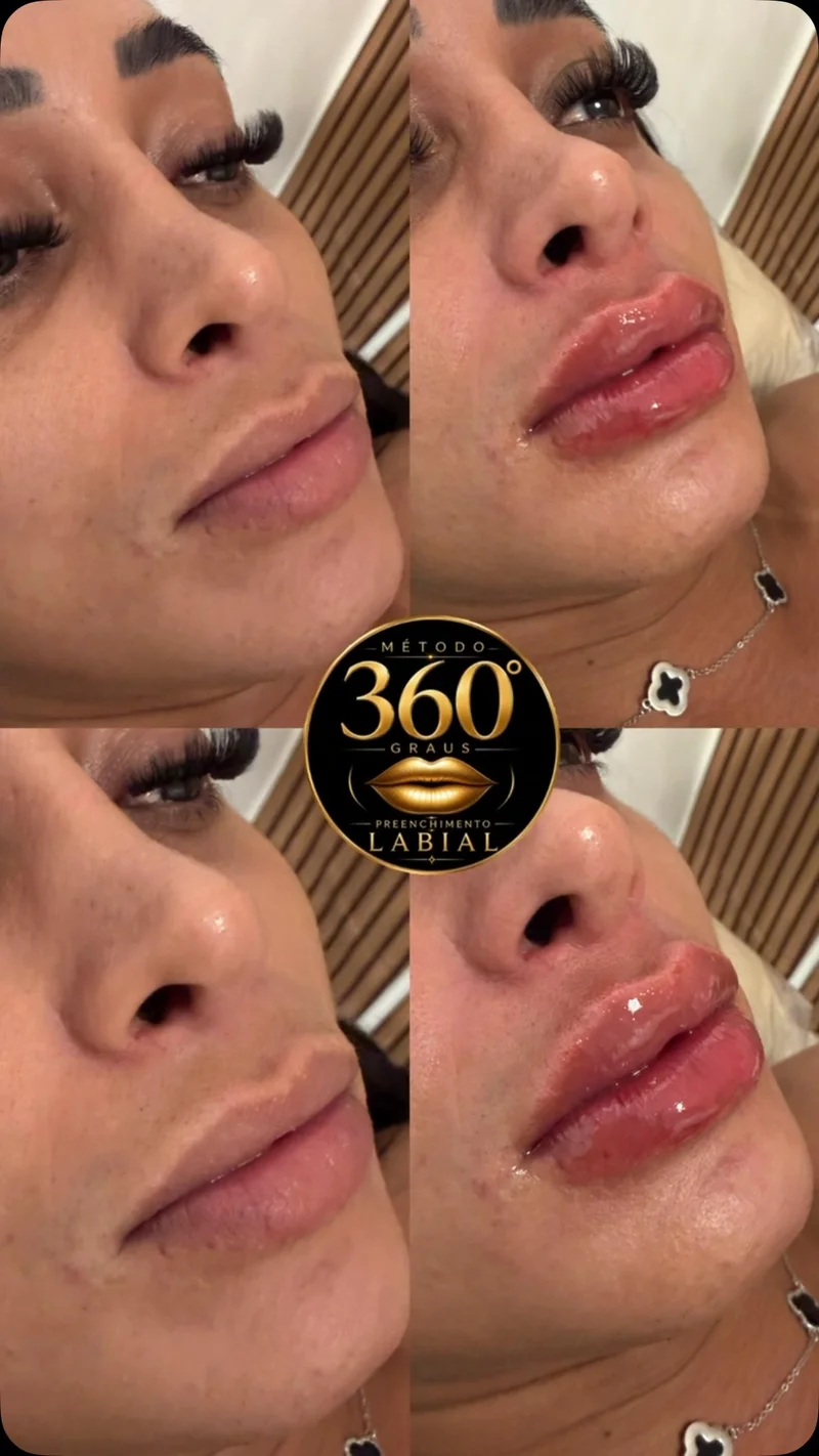 Antes e depois de harmonização labial