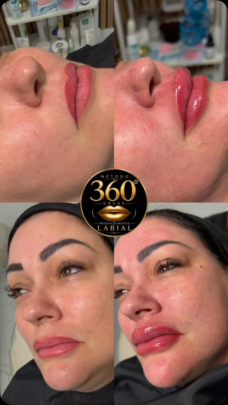 Antes e depois de harmonização labial
