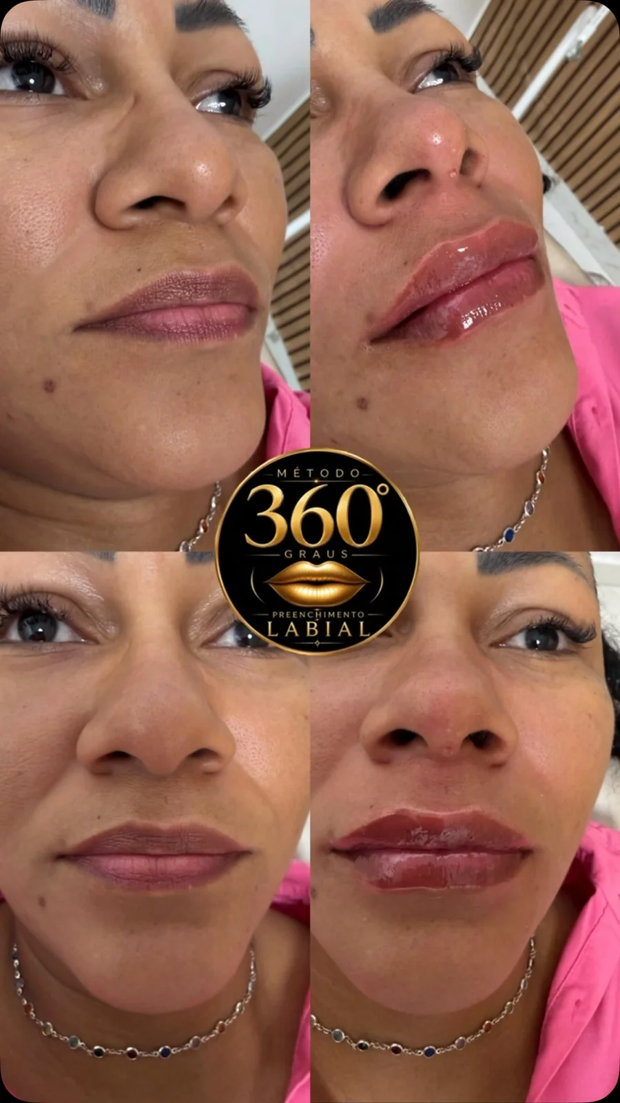 Antes e depois de harmonização labial