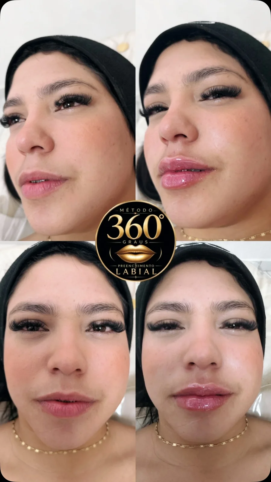 Antes e depois de harmonização labial