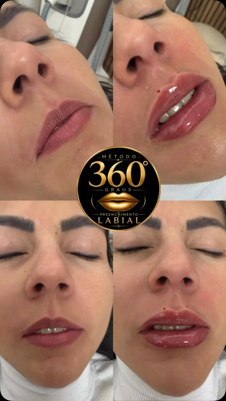 Antes e depois de harmonização labial