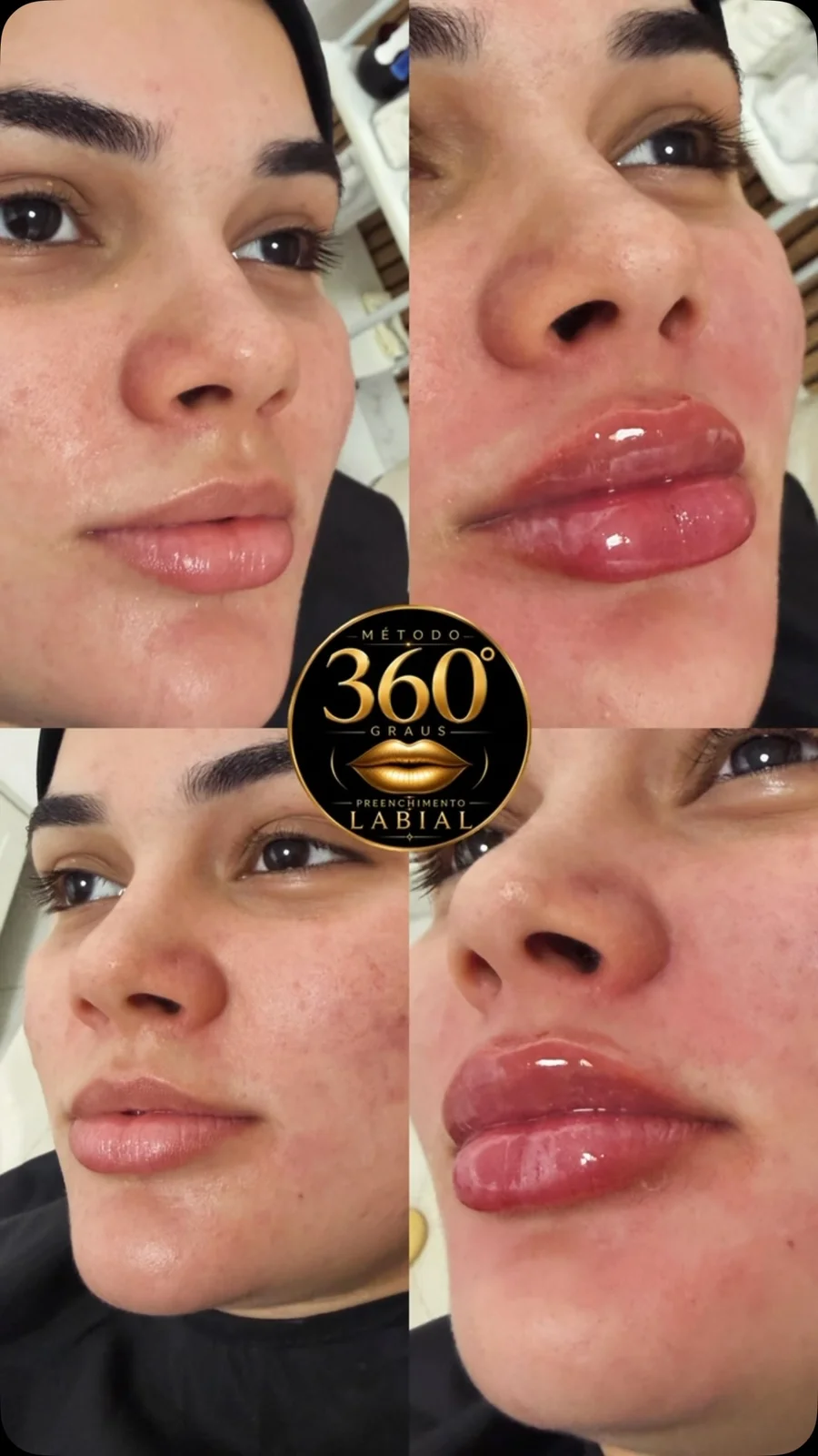 Antes e depois de harmonização labial