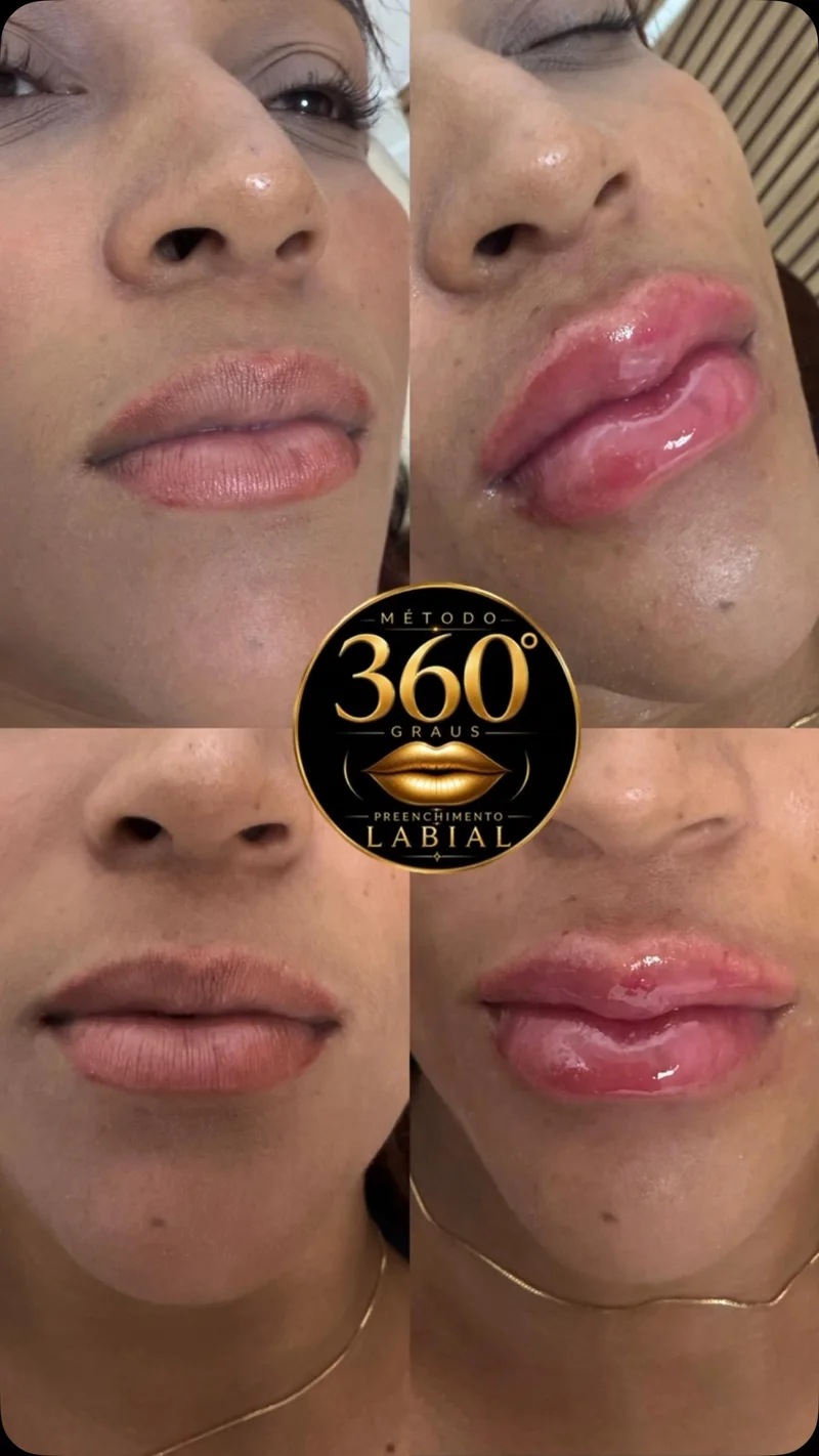 Antes e depois de harmonização labial