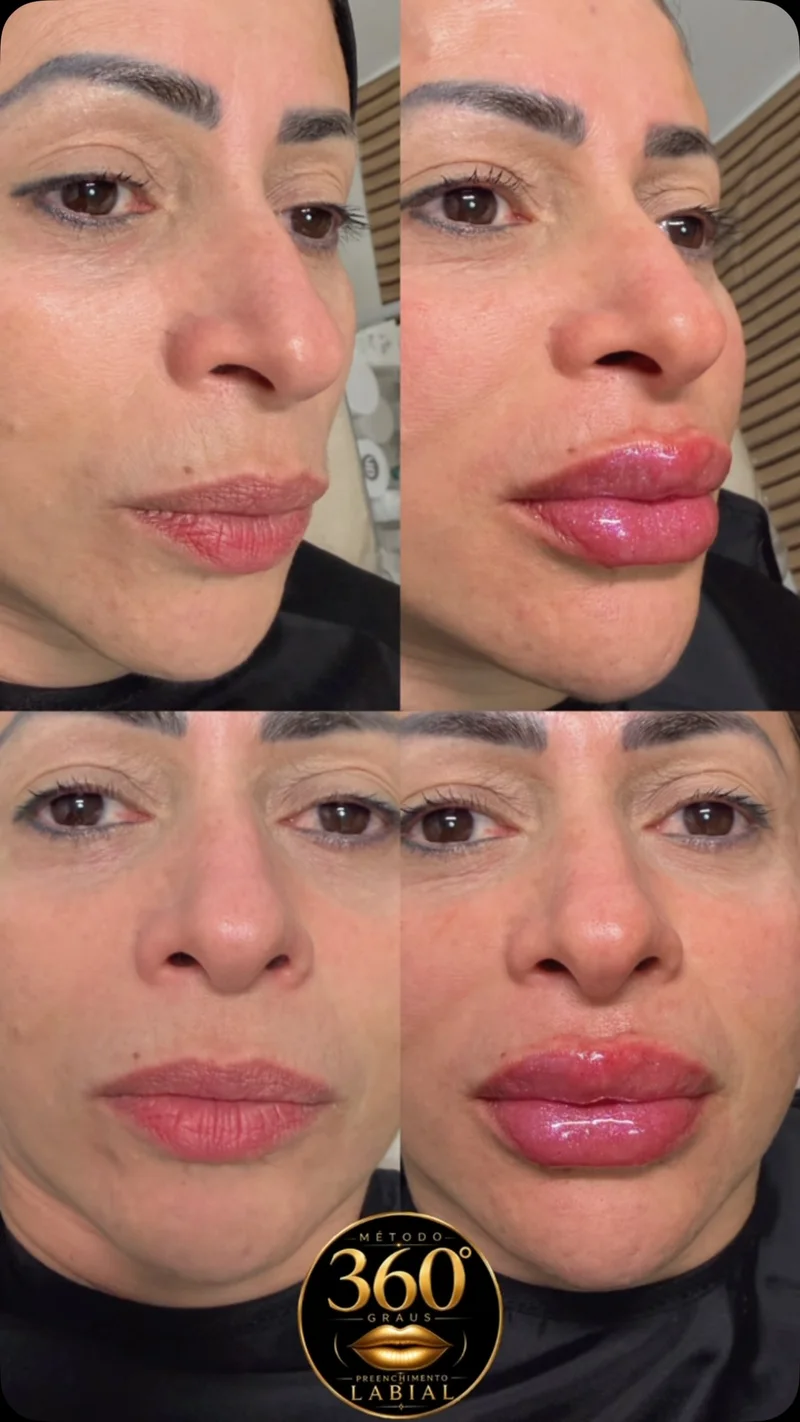 Antes e depois de harmonização labial